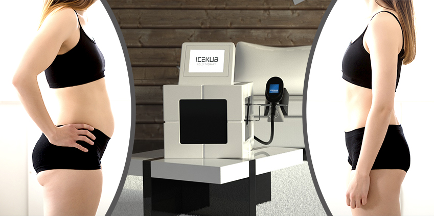 cryothérapie pour maigrir